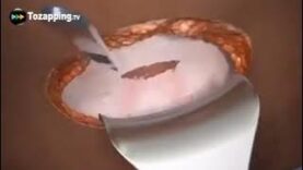 El parto por cesárea